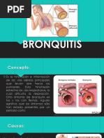 Bronquitis