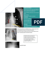 Tension Pneumothorax