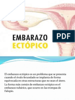 Embarazo Ectopico