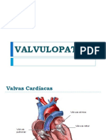 Valvulopatia