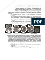 Acidente Vascular Cerebral (AVC) : Os AVC Podem Ocorrer Por Isquemia (Falta de Suprimento Sanguíneo para o