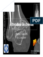 Galois Arthrodese Cheville PDF