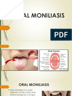 Oral Moniliasis