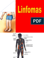 Linfomas 