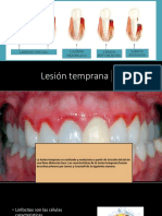 Lesion Temprana 2.0