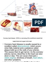 Coronary Heart Disease