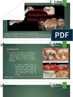 Restauração Semidireta em Dentes Posteriores