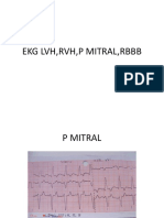 Ekg LVH, RVH, P Mitral, RBBB