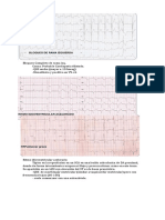 Ejemplos de Electrocardiogramas. 