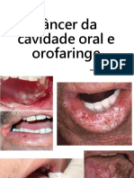 Câncer Da Cavidade Oral