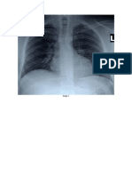 Aortic Coarctation