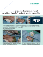 Procedimiento para La Colocacin de Cystofix