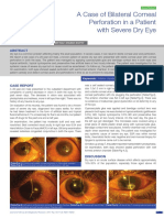 A Case of Bilateral Corneal Perforation in A Patient With Severe Dry Eye in India