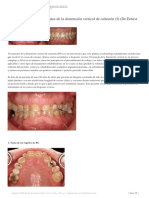 Los 20 Pasos para El Aumento de Dimension Vertical Dr. Ernest Mallat