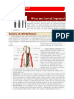 Dental Implant