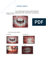 10 - Mordida Aberta