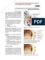 Endoscopic Dacryocystorhinostomy - DCR - Surgical Technique