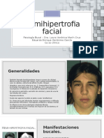 Hemihipertrofia Facial