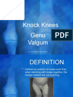 Knock Knees Genu Valgum: by DR - Abdullah Almusallam