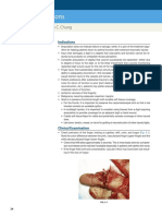 Finger Amputations: Aviram M. Giladi and Kevin C. Chung