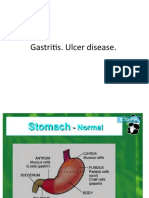 Gastritis. Ulcer Disease