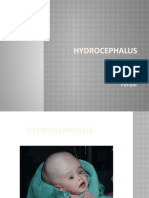 Hydrocephalus: Prepared By: Sita Pariyar