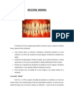 Recesión Gingival