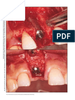 "Sandwich" Bone Augmentation Technique-Rationale and Report of Pilot Cases PDF