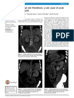 Nana Et Al. - 2014 - Left Renal Vein Thrombosis A Rare Cause of Acute Scrotal Pain PDF