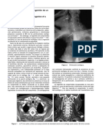 Perforacion Esofagica Tras Ingestion de Comprimido en Blister