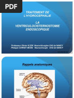 Traitement de L Hydrocephalie