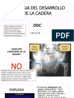 Displasia Del Desarrollo de La Cadera