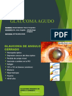 Glaucoma Agudo