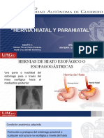 Hernia Hiatal y Parahiatal