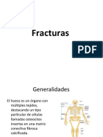 FRACTURAS