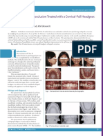 Feature: Class II Division 1 Malocclusion Treated With A Cervical-Pull Headgear: A Case Report