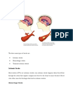 Types of Stroke