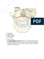 Osteotomía Le Fort 1