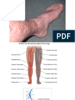 Varicose Vein