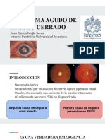 Glaucoma Agudo de Ángulo Cerrado