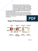 Giant-Cell Tumor of Bone (GCT) Is Bone Primary Tumor That Usually Happen in Young Adult Between 20-40 Years Old