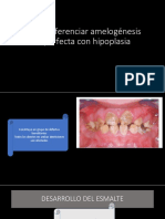 Como Diferncias Amelogénesis Imperfecta Con Hipoplasia