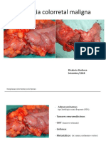 T4-Carcinoma Colorretal Esporádico