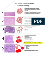 Prostate Acinar Adenocarcinoma Gleason Grading: Often Disqualifies From Active Surveillance