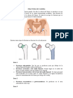 Fractura de Cadera