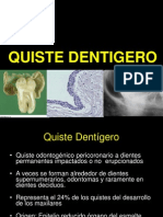 Quiste Dentigero