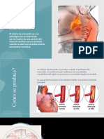 Infarto de Miocardio (IAM)