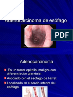 Adenocarcinoma de Esófago