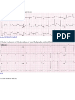 1 Acute Inferior Wall MI With First Degree Block