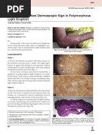 Ring Scales: A New Dermoscopic Sign in Polymorphous Light Eruption